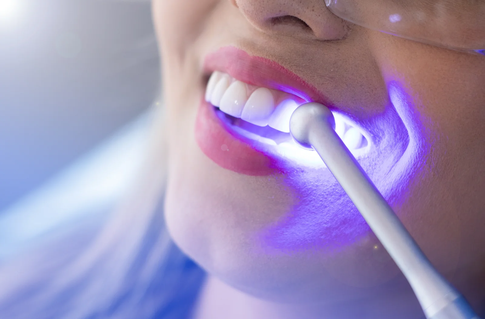 Teeth Whitening