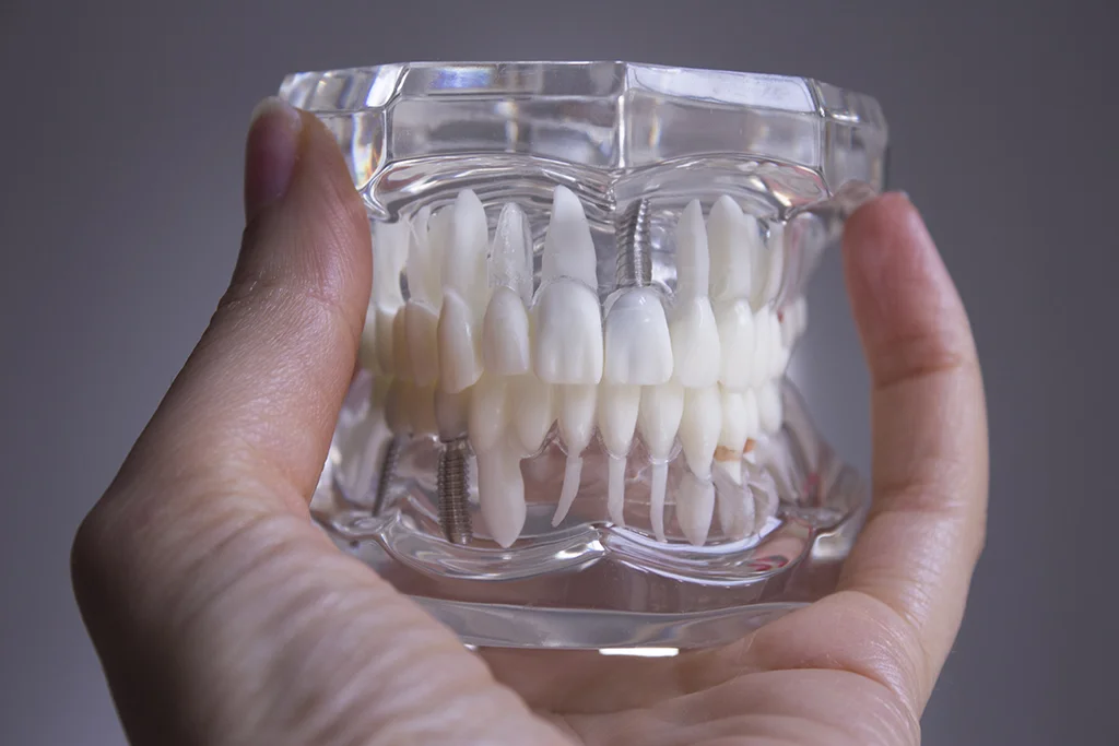 Dental Bridges