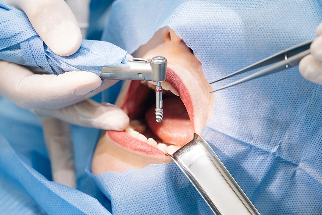 Tooth Extraction