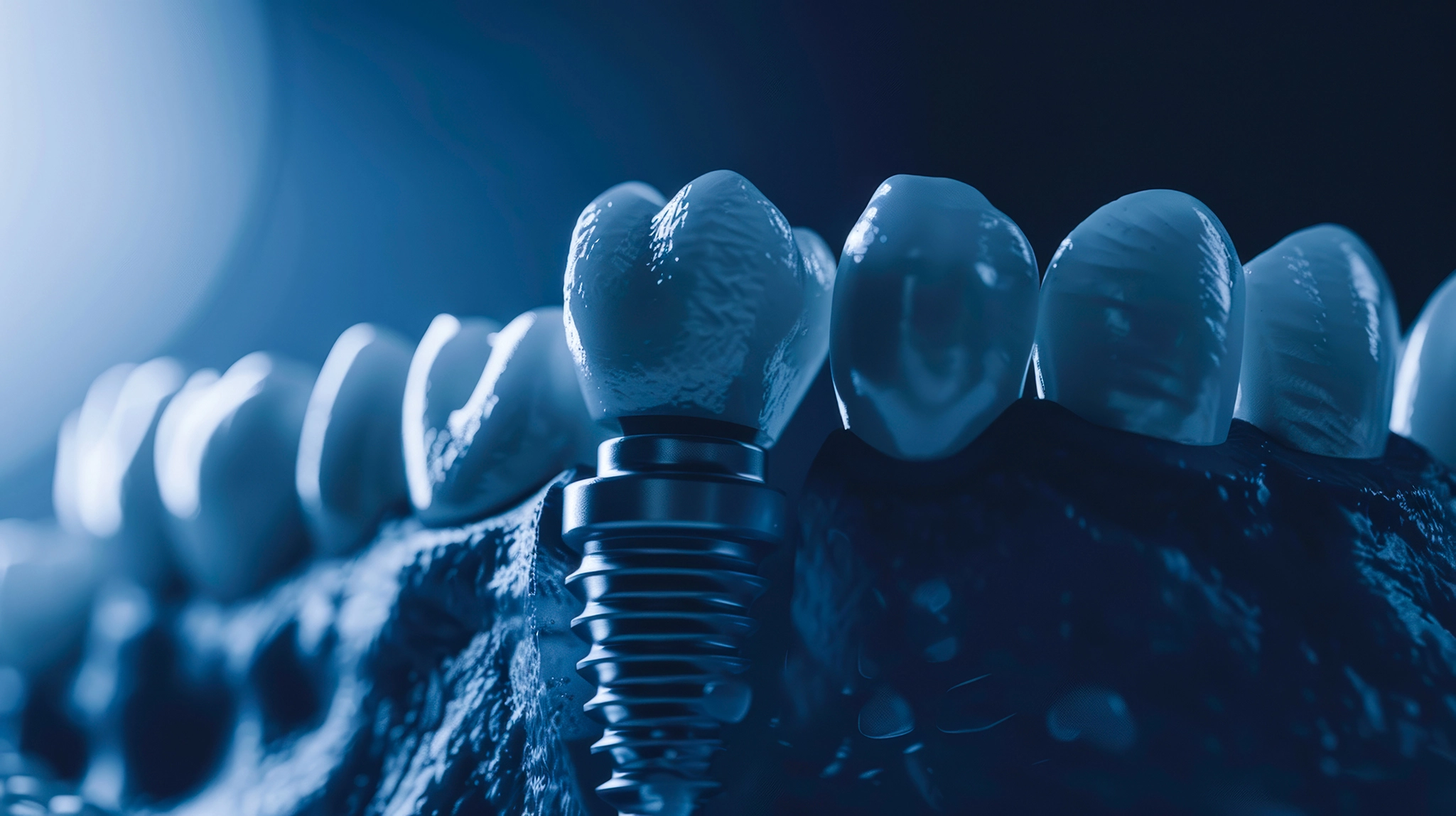 Transform Your Smile: The Ultimate Guide to Antalya Dental Implants